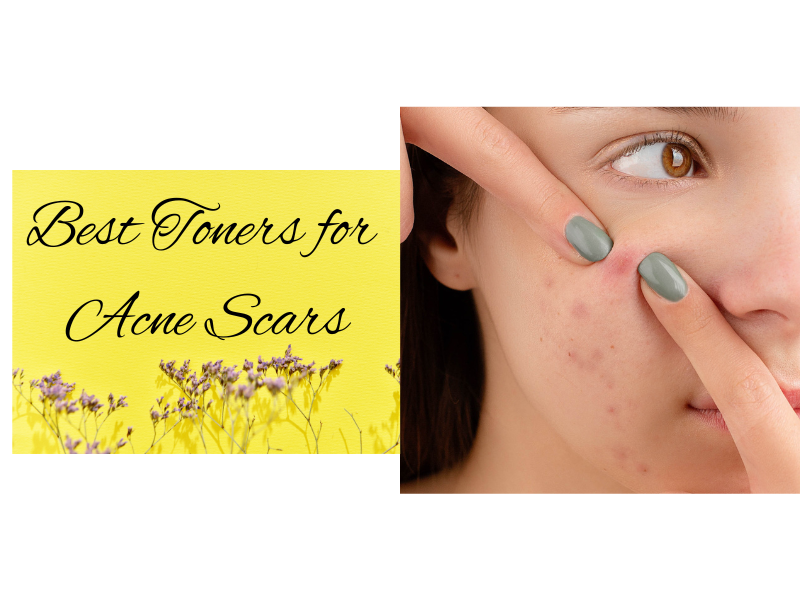 Best Toners for Acne Scars
