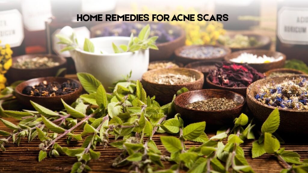 Top 5 Home Remedies for Acne Scars 