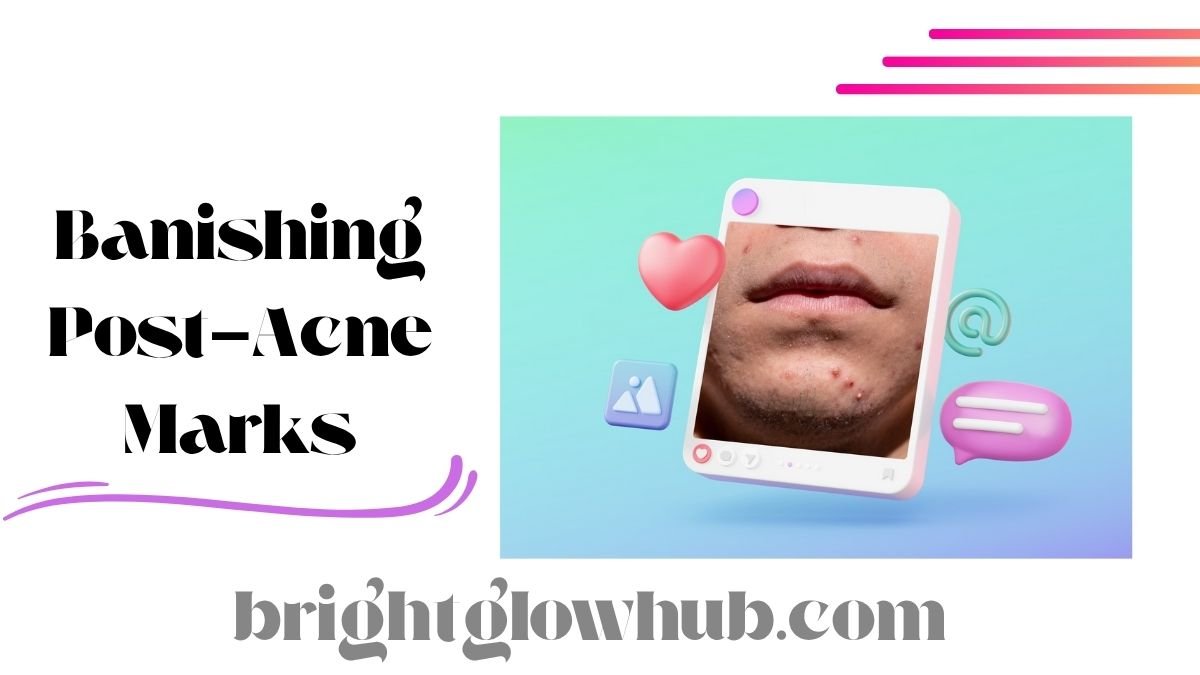 Banishing Post-Acne Marks
