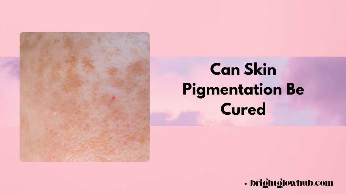 Can Skin Pigmentation Be Cured